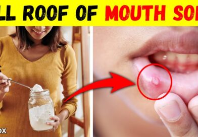 How To Get Rid of Roof of Mouth Sore at Home